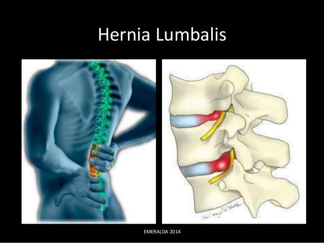 Hernia Diafragmatika Pdf Download
